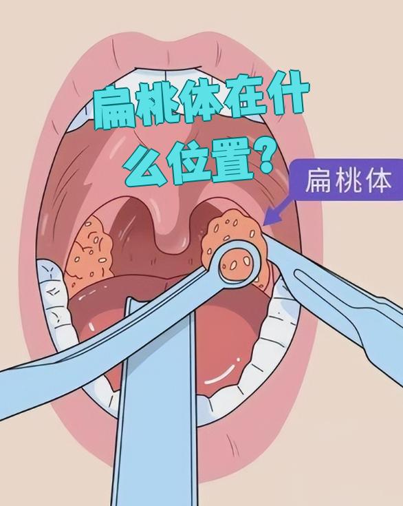 扁桃体在什么位置?