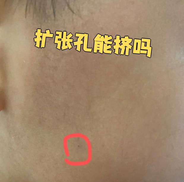 扩张孔是皮肤上的一种小孔,通常位于耳垂,鼻翼等部位,其作用是促进