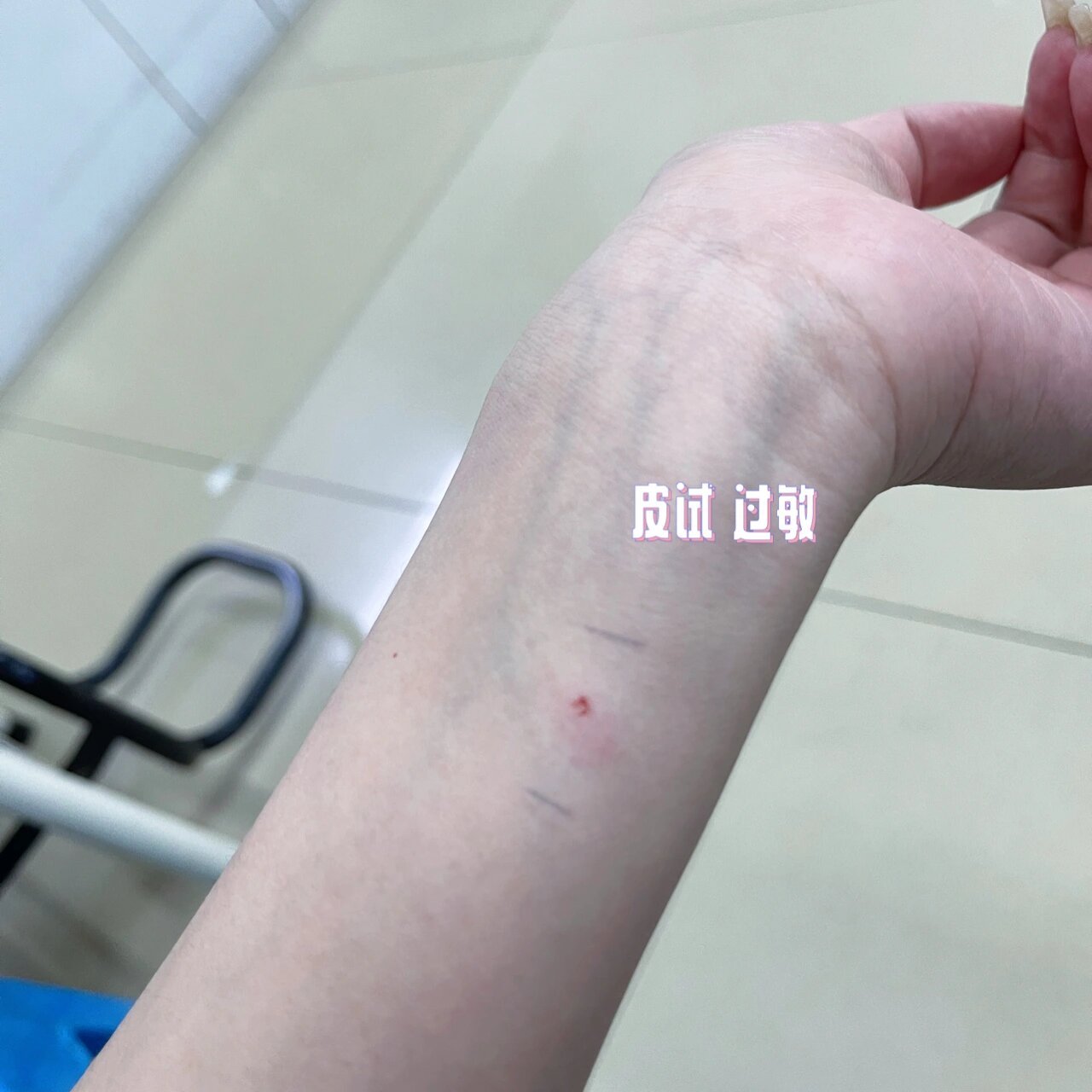 打破伤风免疫球蛋白 脚被钉子扎了 打破伤风皮试过敏 后来打了破伤风