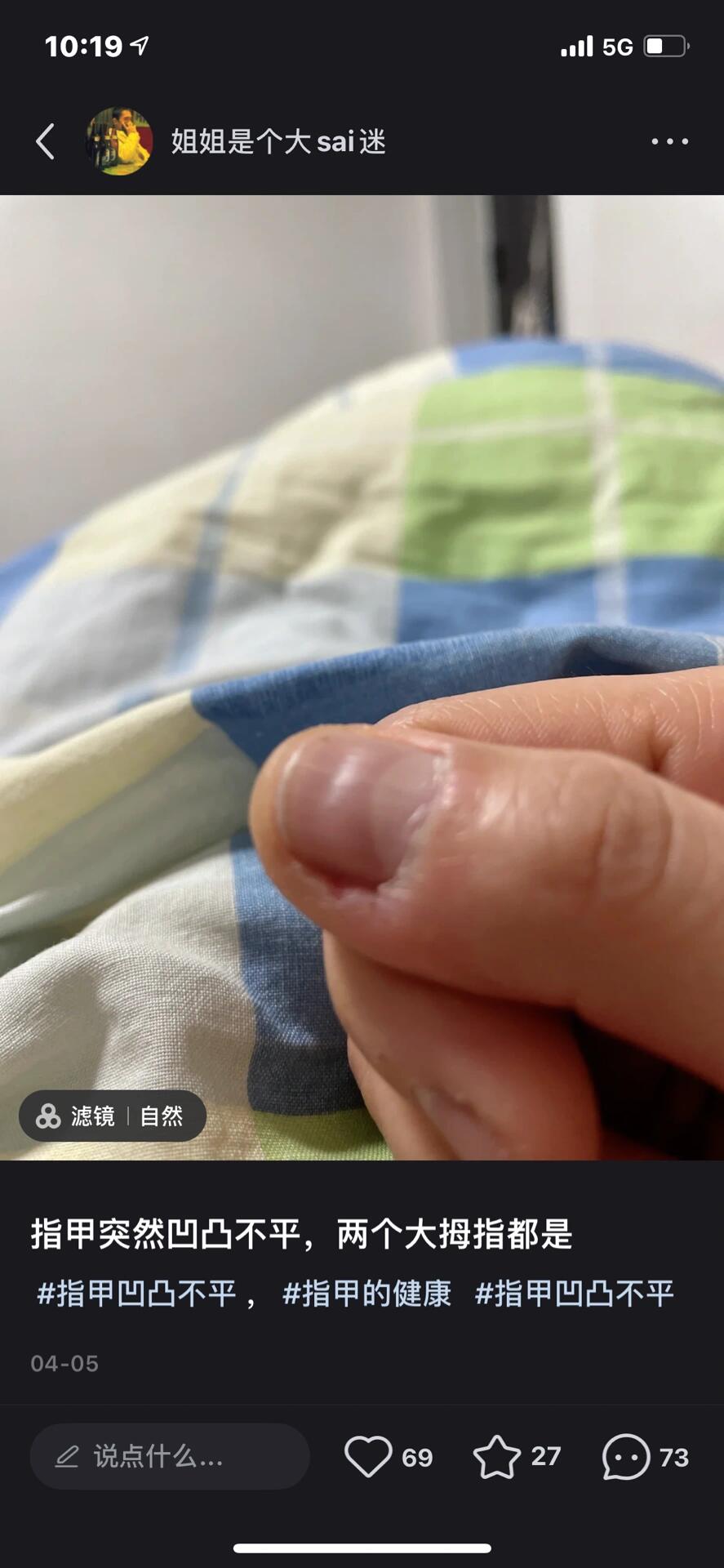 指甲不凹了,四月和现在的对比 当时上网说是缺微量元素,就从京🕳