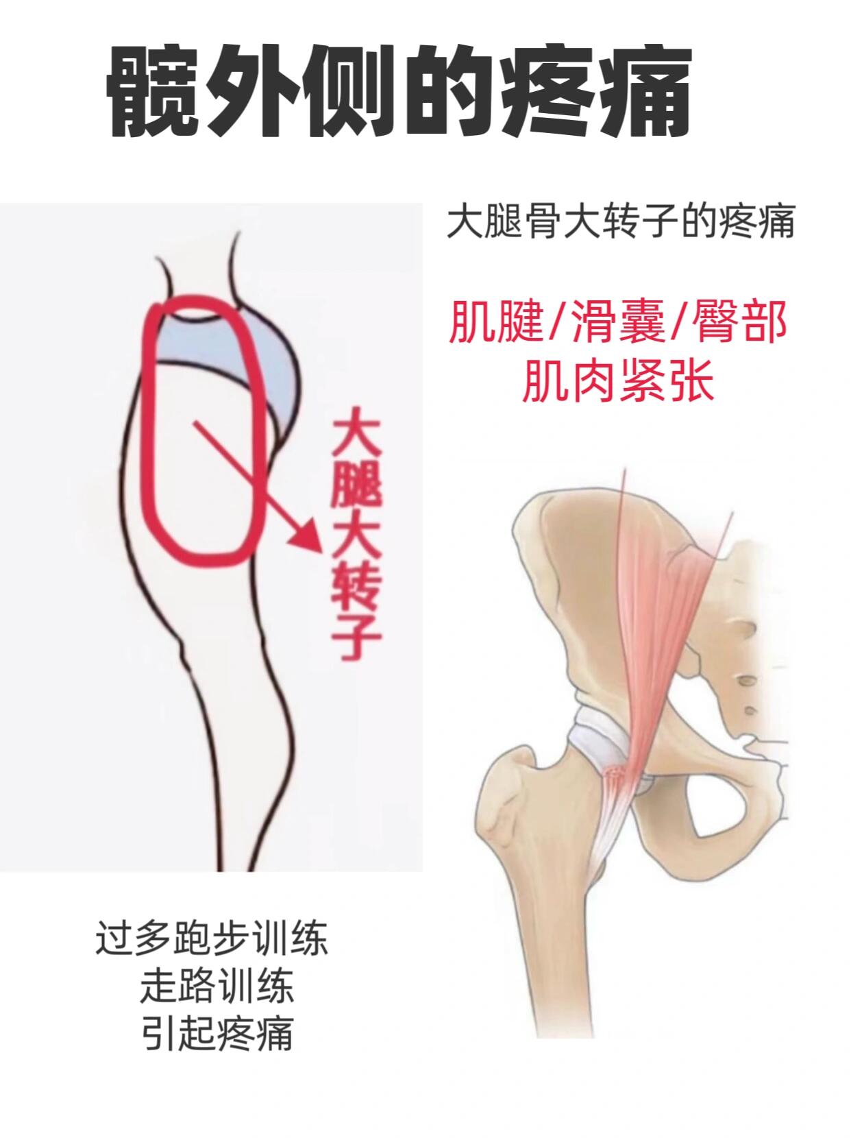 股骨头疼的位置图片图片