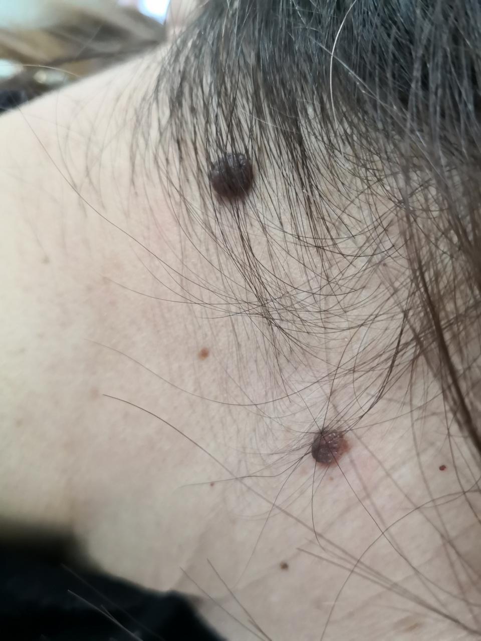 颈周及背部的色素痣和脂溢性角化/老年斑症状.#色素痣##激光美容