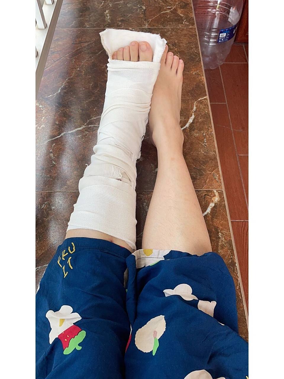 骨折日记7:自家动手拆石膏 在网上买的弹力绷带到了,刚好在医院重新