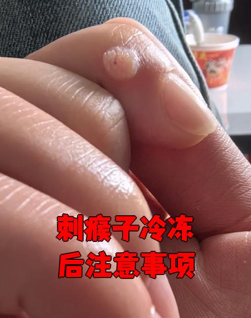 刺瘊子也叫寻常疣,冷冻治疗是用低温冷冻病变组织,让细胞内外形成