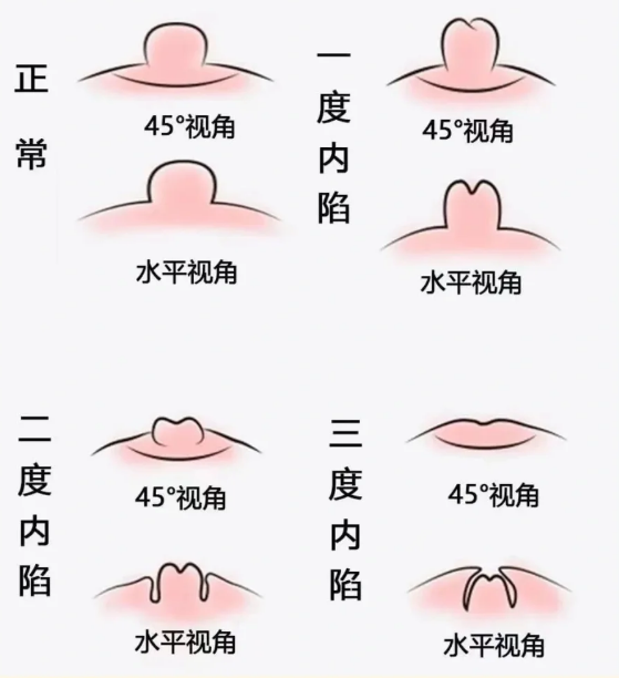 男性乳头凹陷不一定是病.有些人是天生的,有些则是疾病引起的