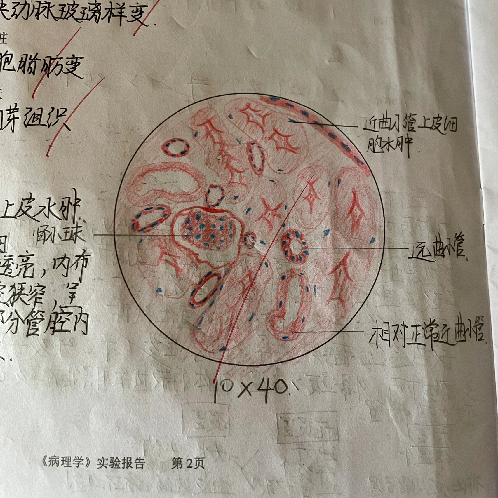 病理学红蓝铅笔绘图～ p1:肾近曲小管上皮水肿 p2:皮下组织多发性脓肿