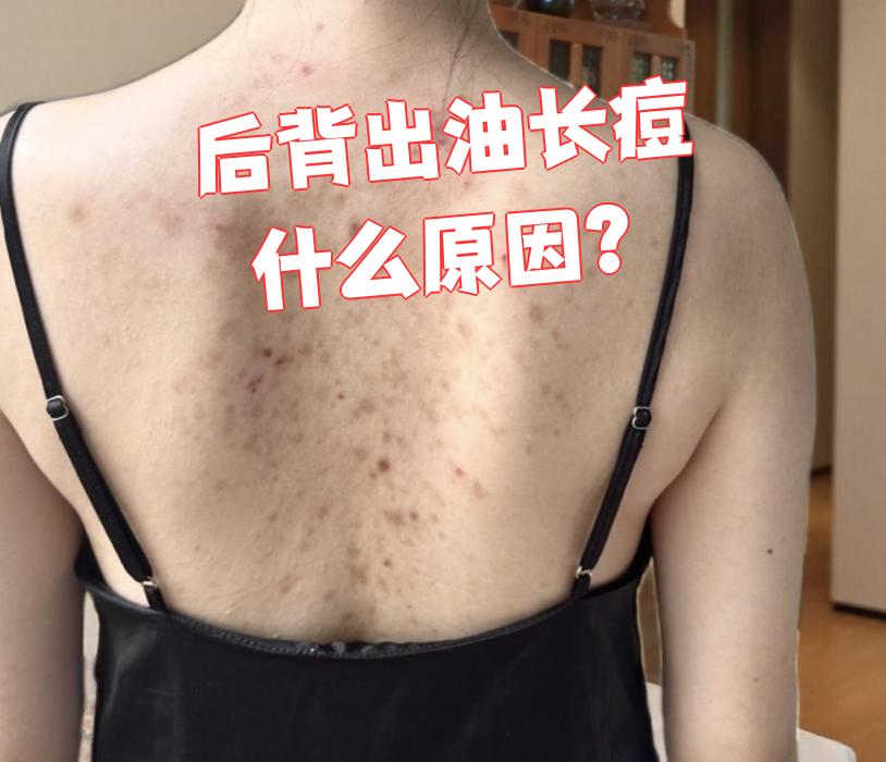 脂溢性皮炎通常发生在皮脂分泌过多的部位
