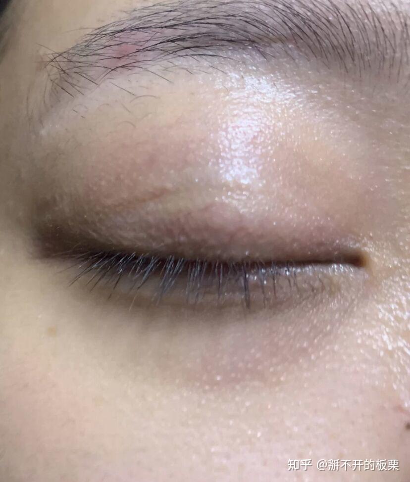 双眼皮术后如何预防疤痕增生