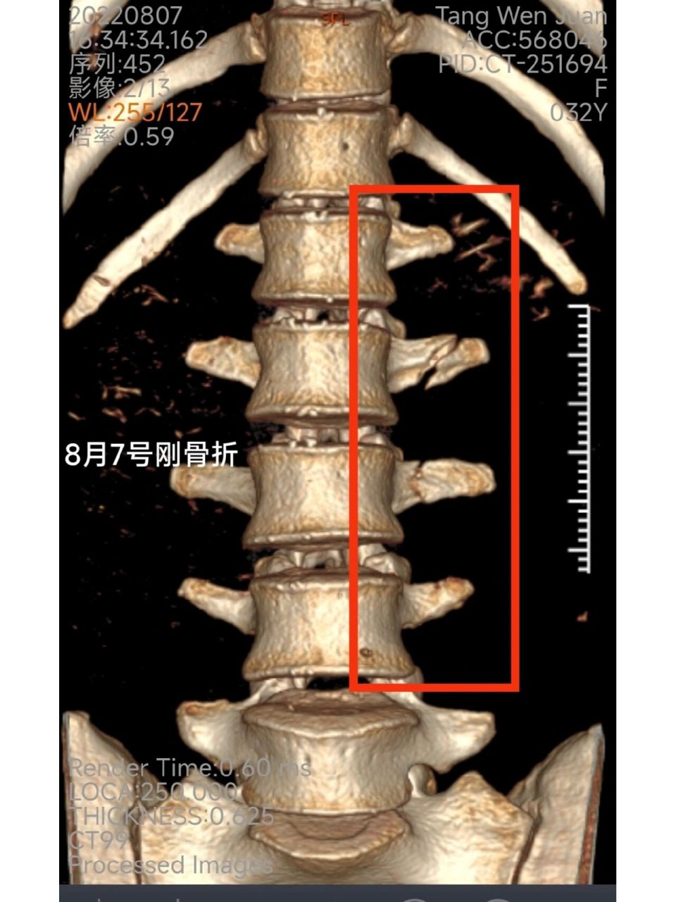 颈椎横突骨折图片