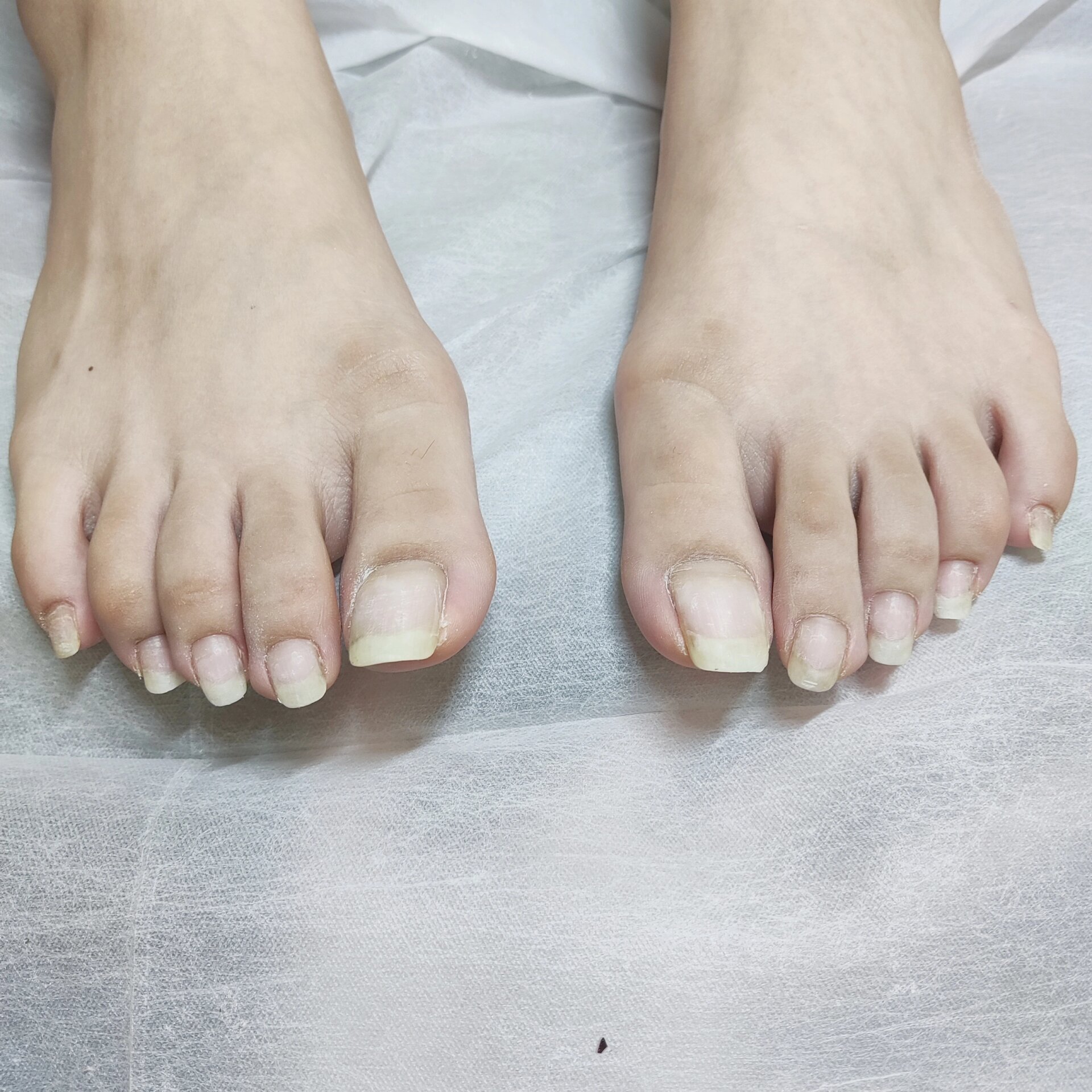 这脚趾甲是我见过最长的了!