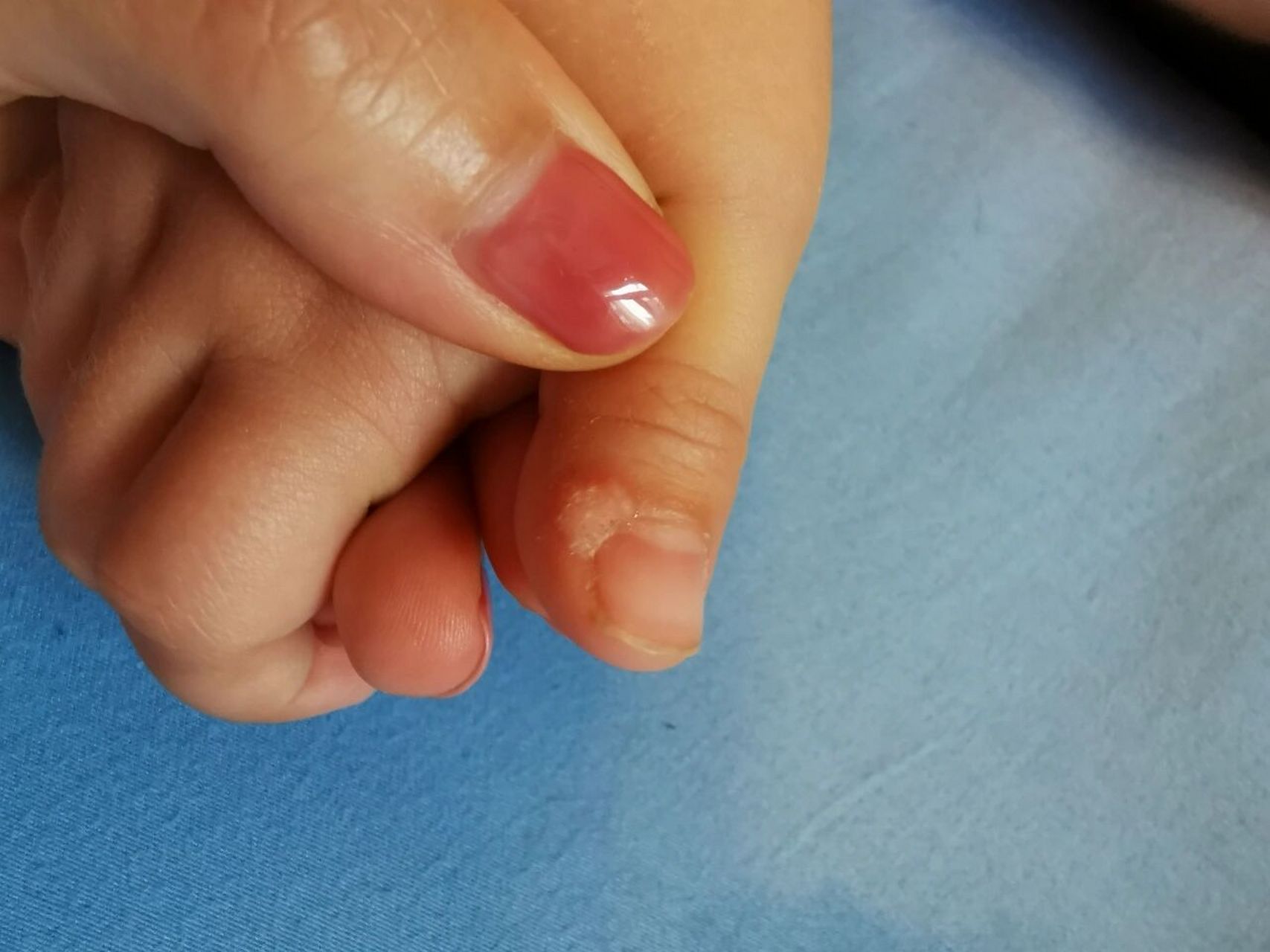 刺猴好了分享给大家 孩子三岁多的时候手上长了一个白色的刺猴  去