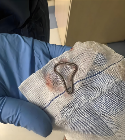 目前最常用的是带铜的宫内节育器,适合没有禁忌症的育龄女性