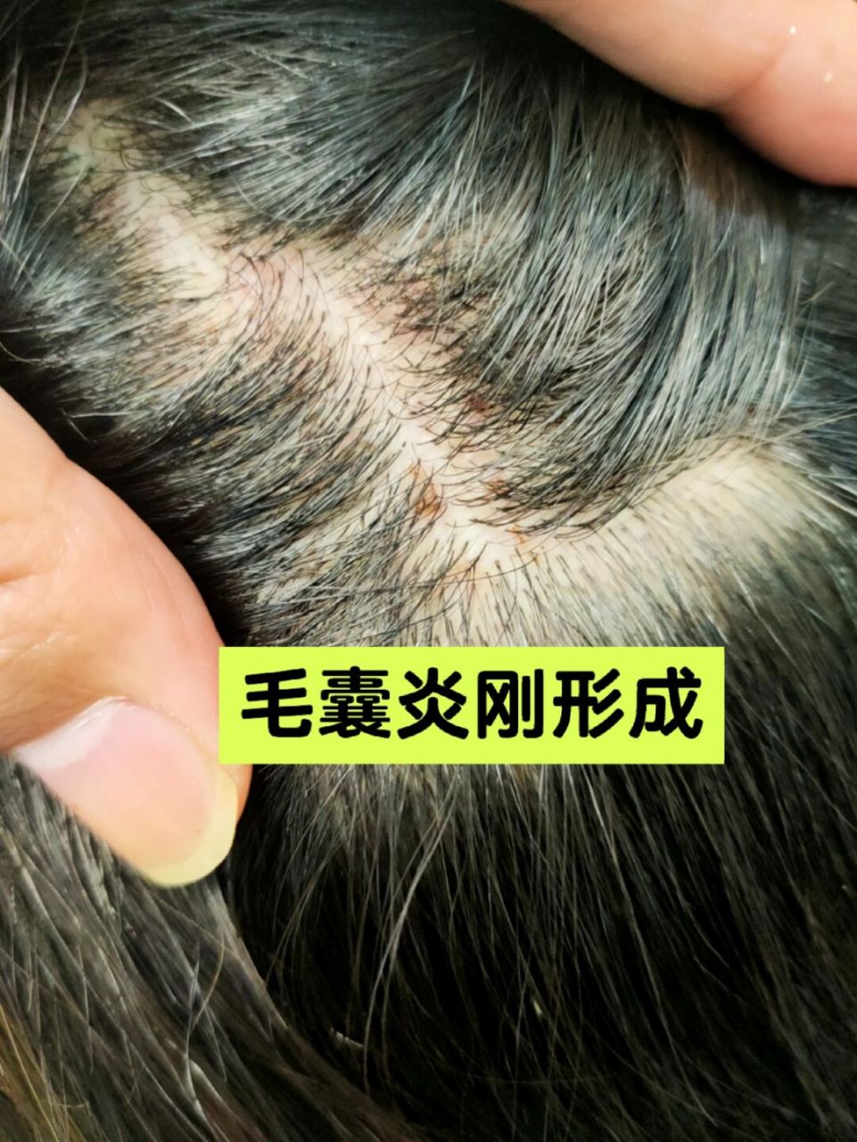 她说这几天就是感觉头发种痒性,头皮屑洗不掉, 这就是毛囊炎的最初