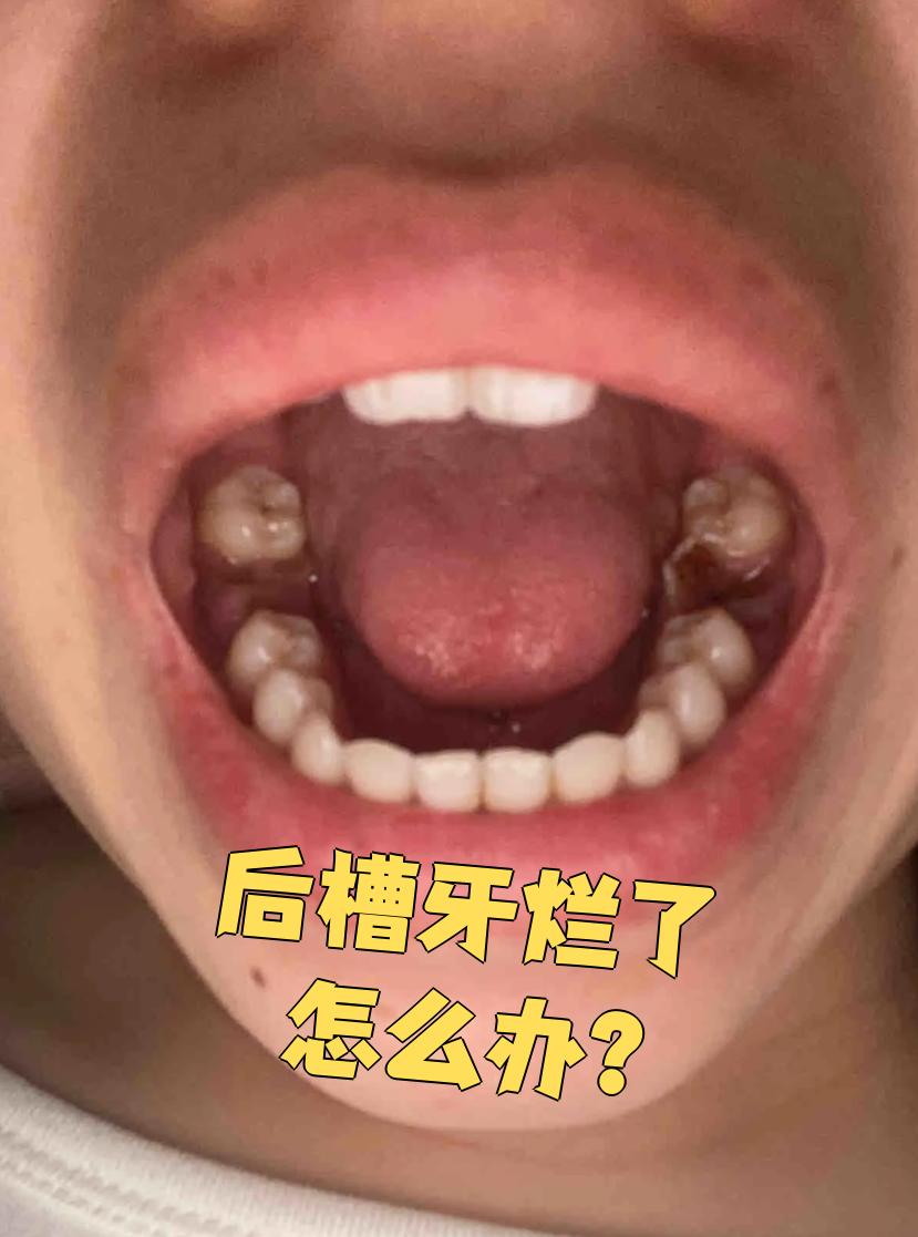 磨损:经常用后槽牙咬硬东西会把牙齿磨坏,看起来就像烂了