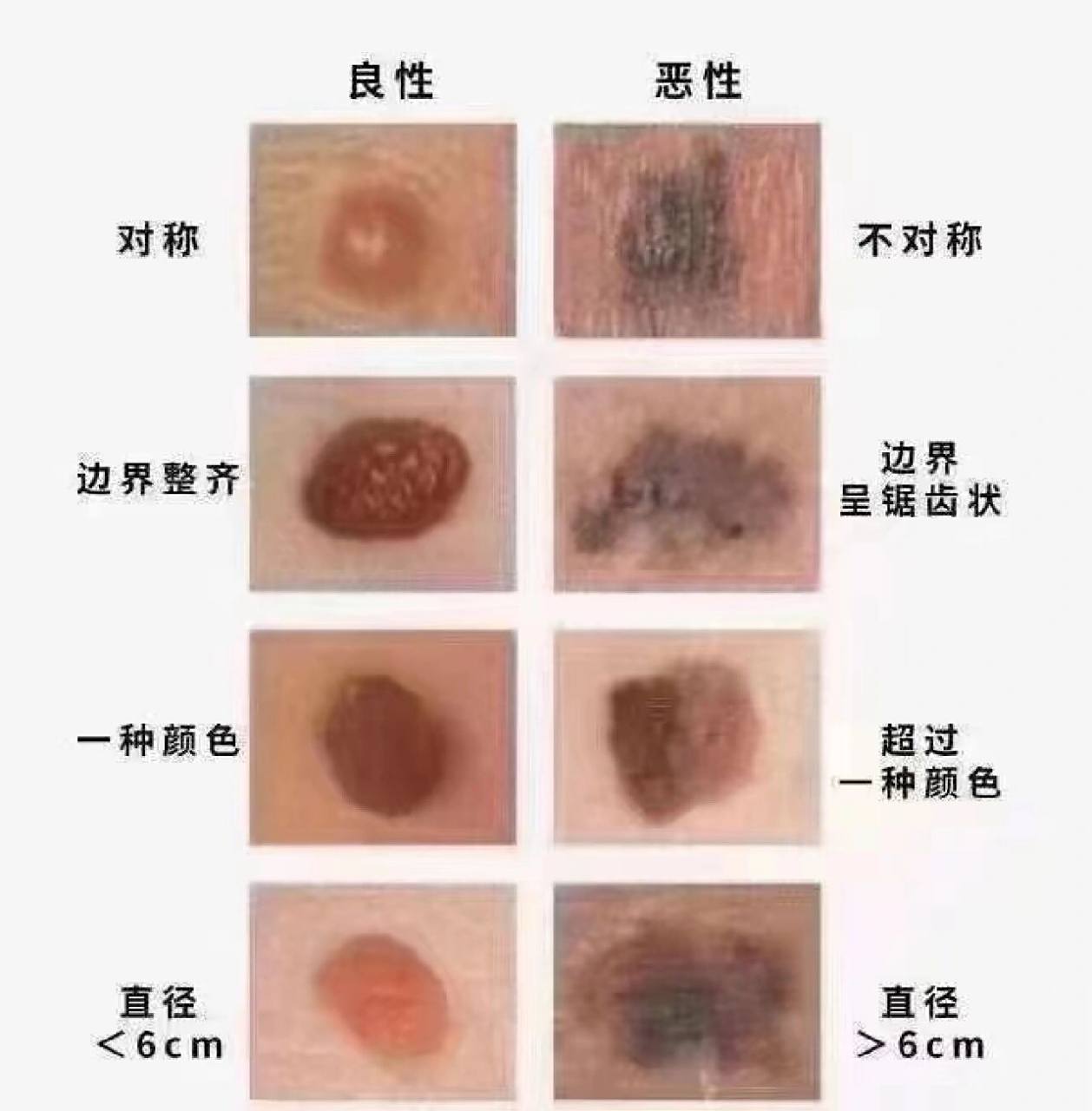 78什么样的痣容易发生病变:166形状不规则 非对称266颜色深浅不