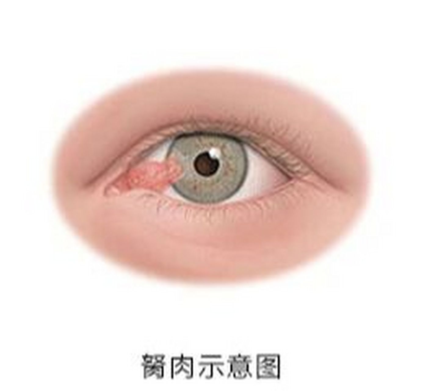 一,翼状胬肉:翼状胬肉因其形状酷似昆虫的翅膀而得名,胬肉位于睑裂部