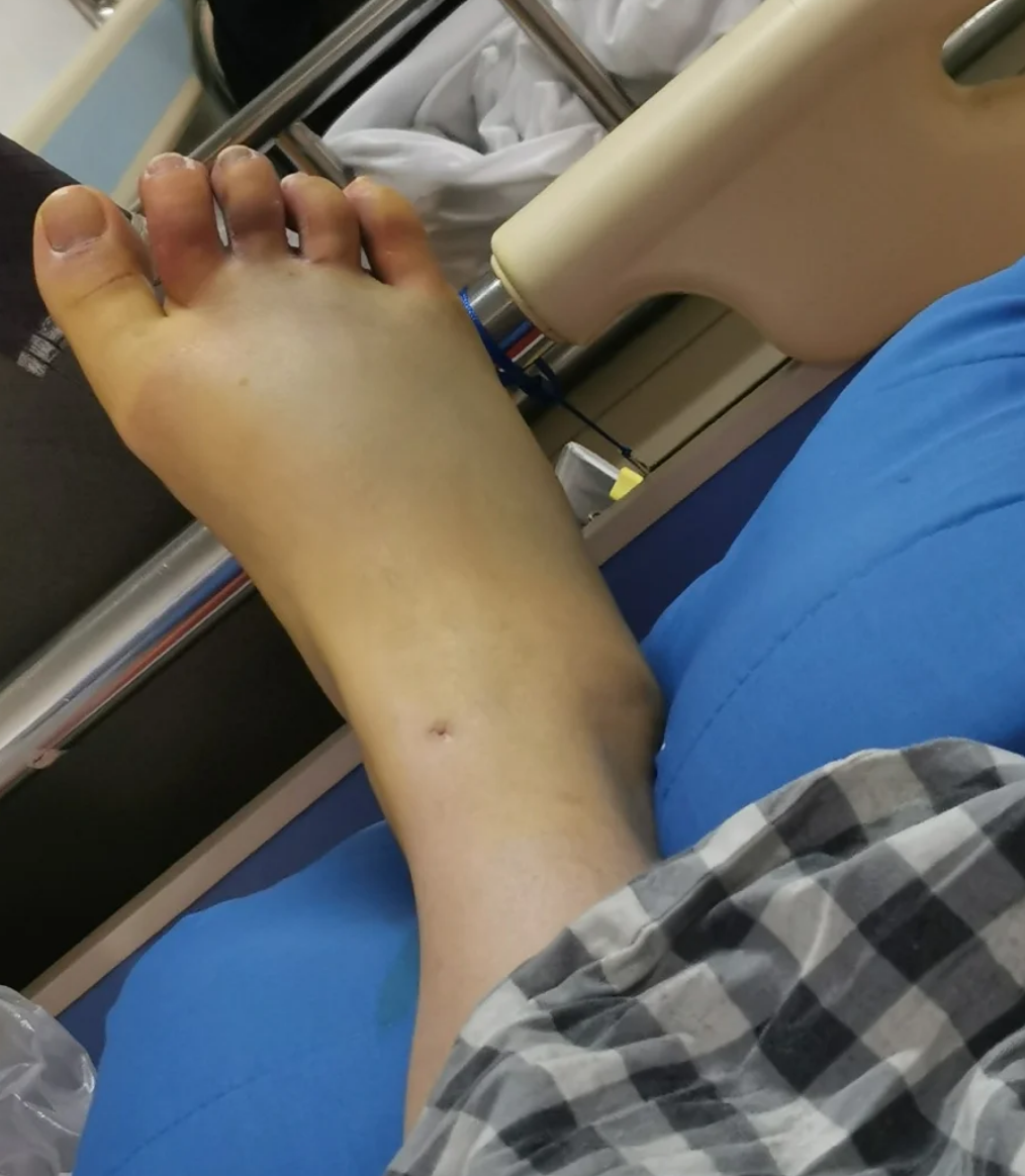 脚趾被砸伤后拍片没看到明显骨折,这种情况很可能是软组织损伤