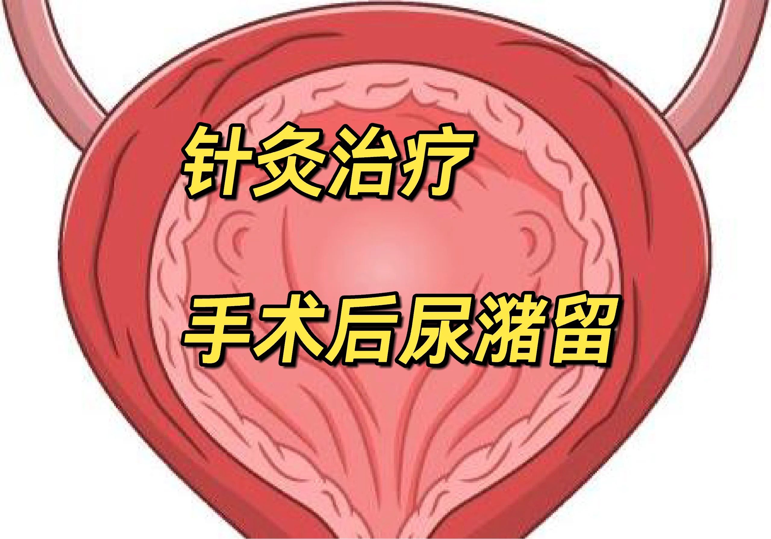 针灸治疗手术后长期尿潴留案 中山大学附属第一医院针灸科02 邓元江