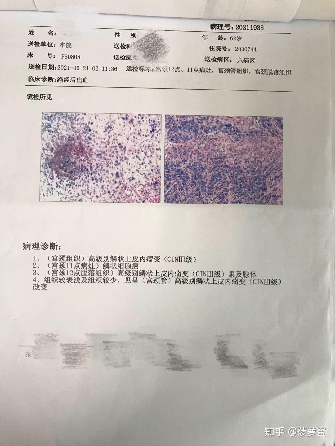 宫颈活检结果图图片