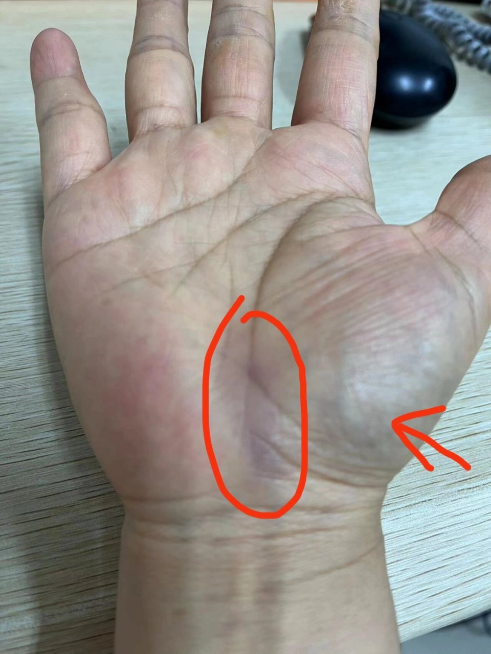 手掌根部淤青是啥情况啊 刚刚洗手发现右手掌根部有一片淤青,按压感觉