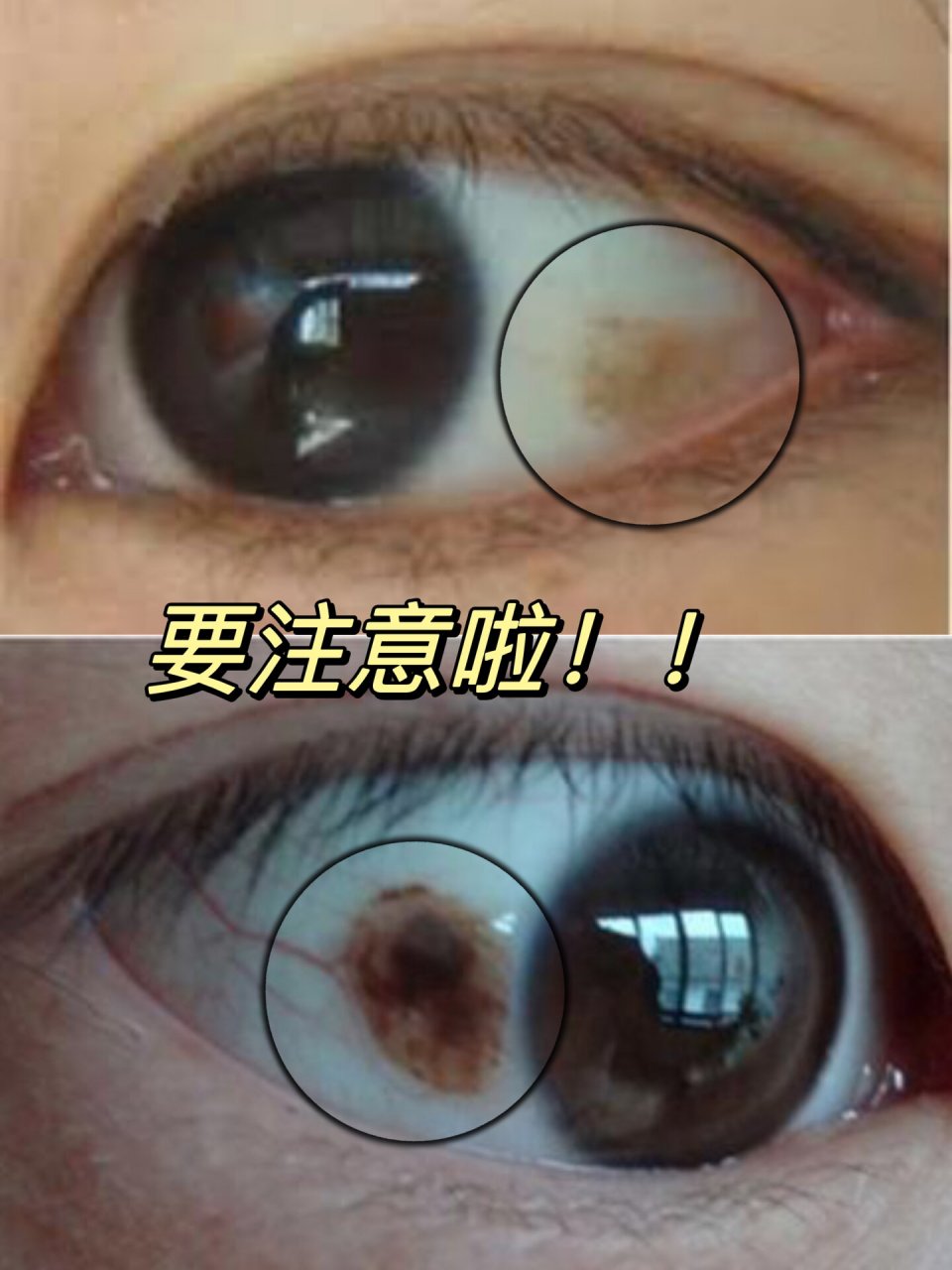 加拿大9896中老年眼睛黄斑病变(amd)怎么办 在我们身边中老年眼睛