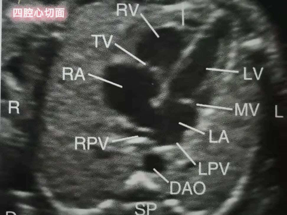 胎儿心脏—四腔心切面 1,心脏的2/3位于左侧胸腔内,心尖指向左前方