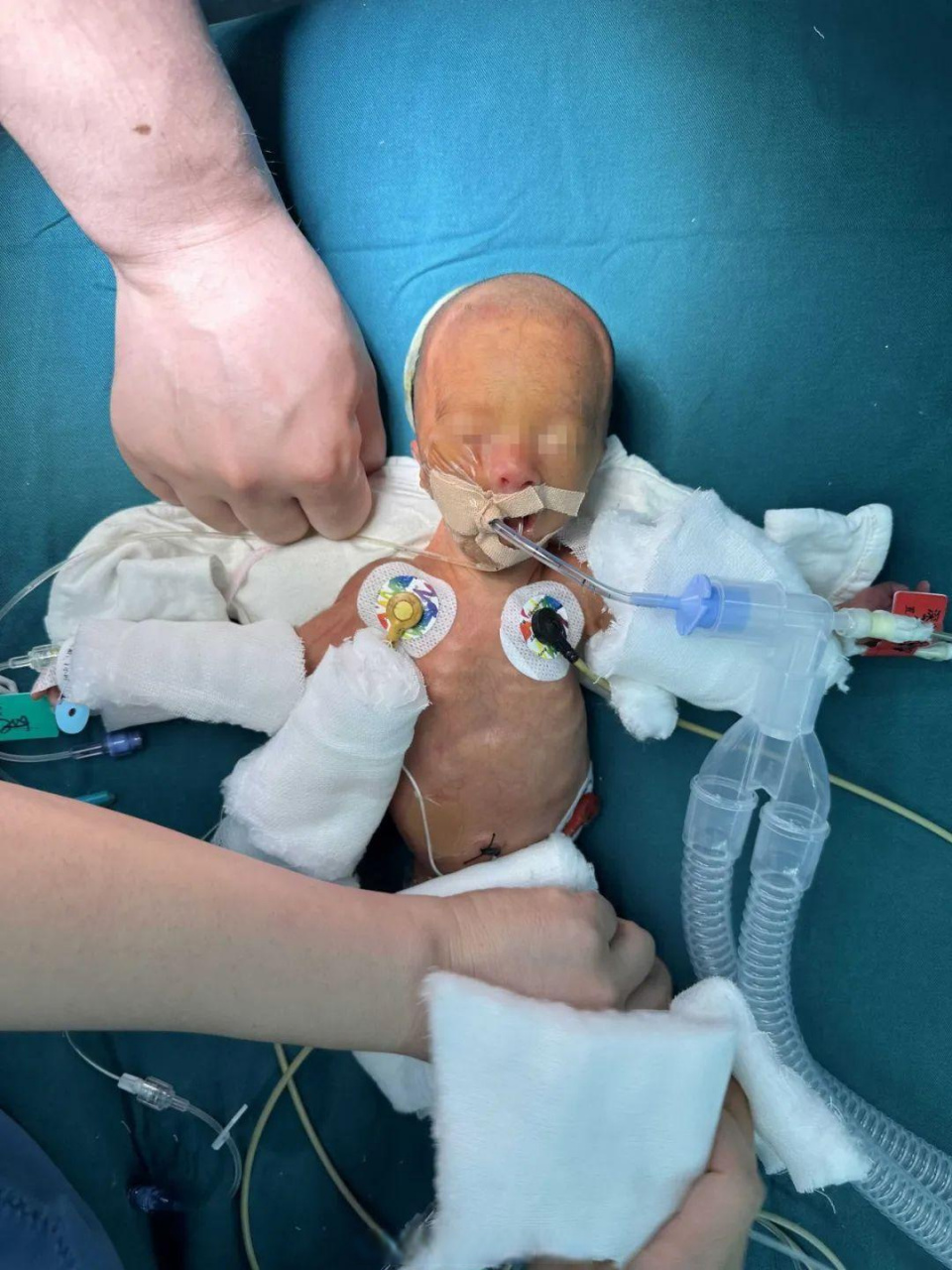 不足三斤的脑出血早产儿被救治】近日,西北妇女儿童医院神经外科为一