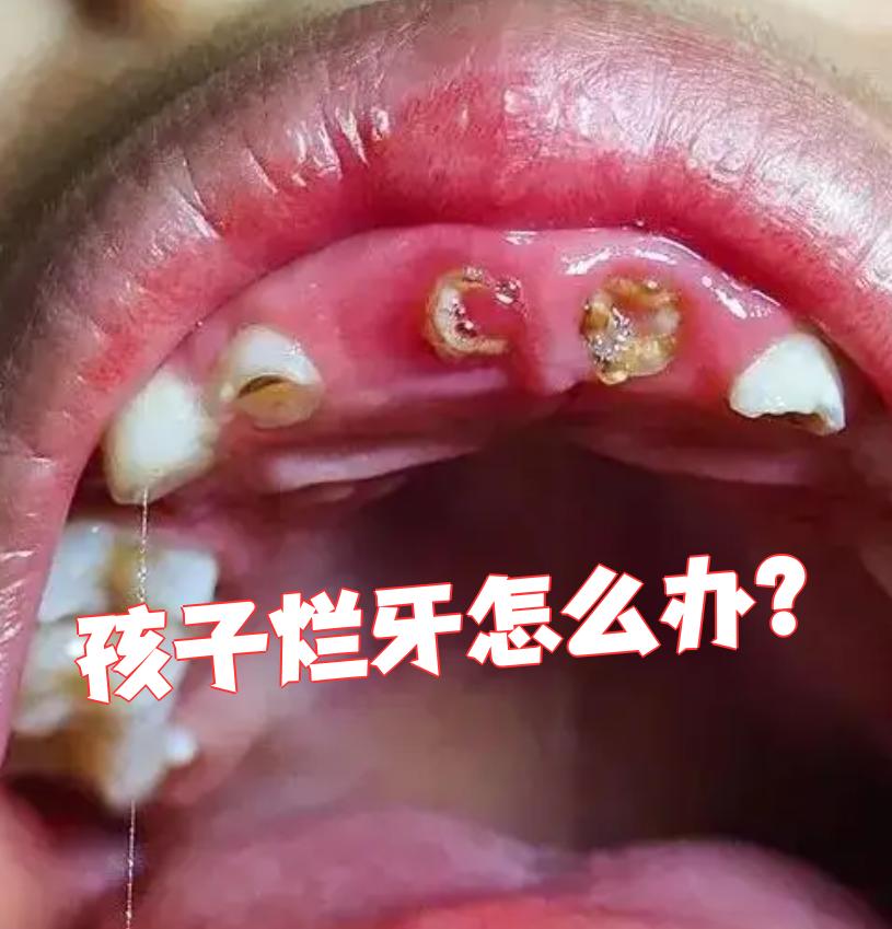 这些药能杀菌,保护牙齿