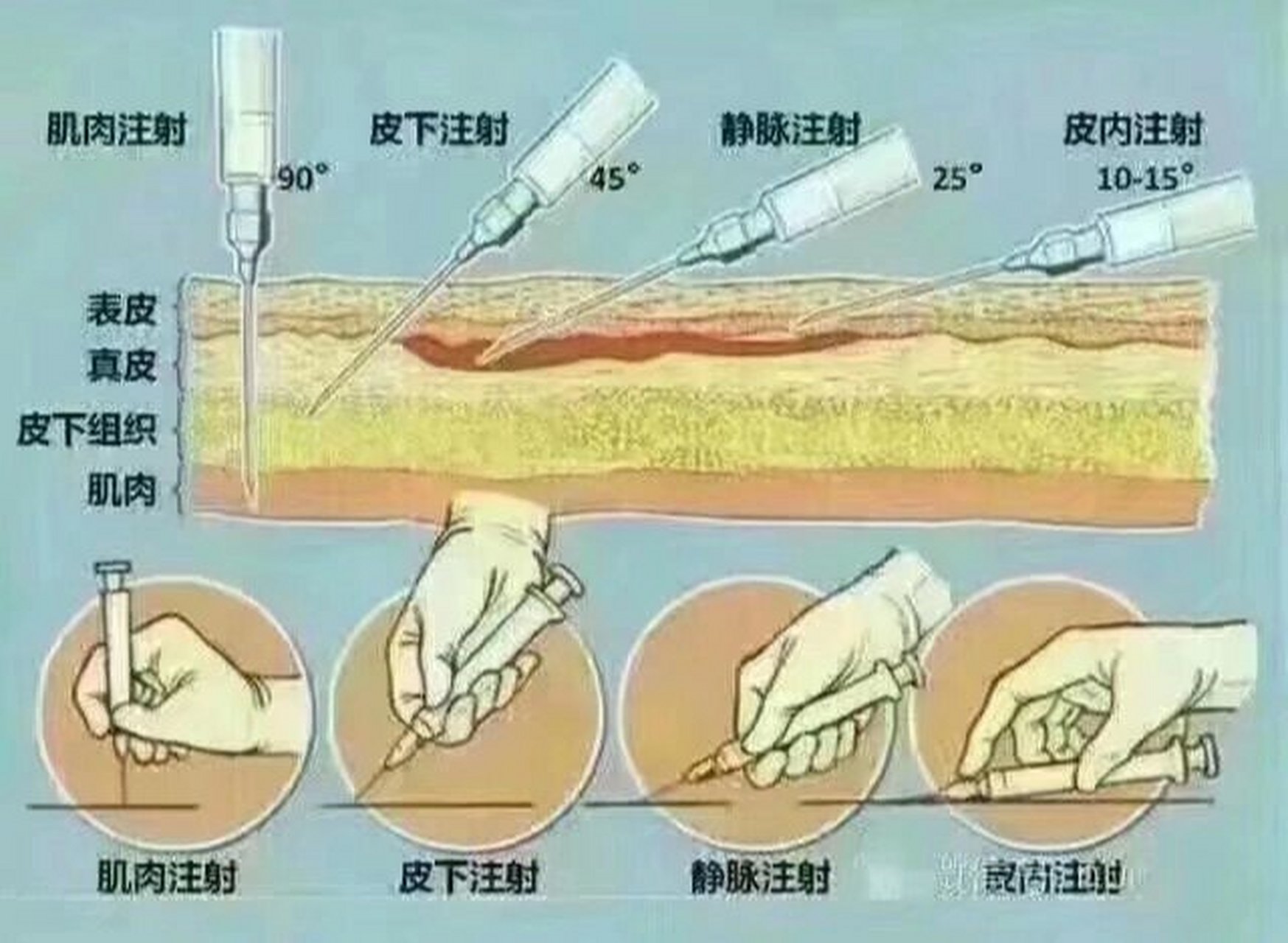 注射法进针角度 9595各种注射法的进针角度 9696皮内注射法