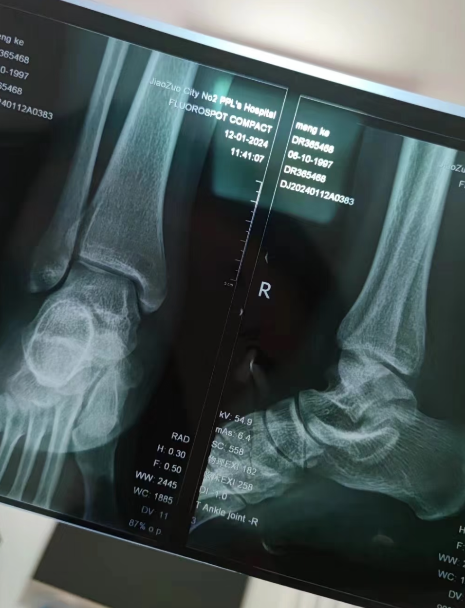 脚踝关节疼痛很常见,可能只是走路太多,也可能是外伤,痛风,骨质疏松