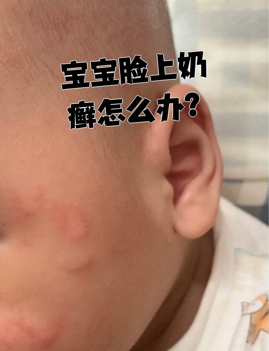 宝宝脸上出现奶癣,可以这样处理: