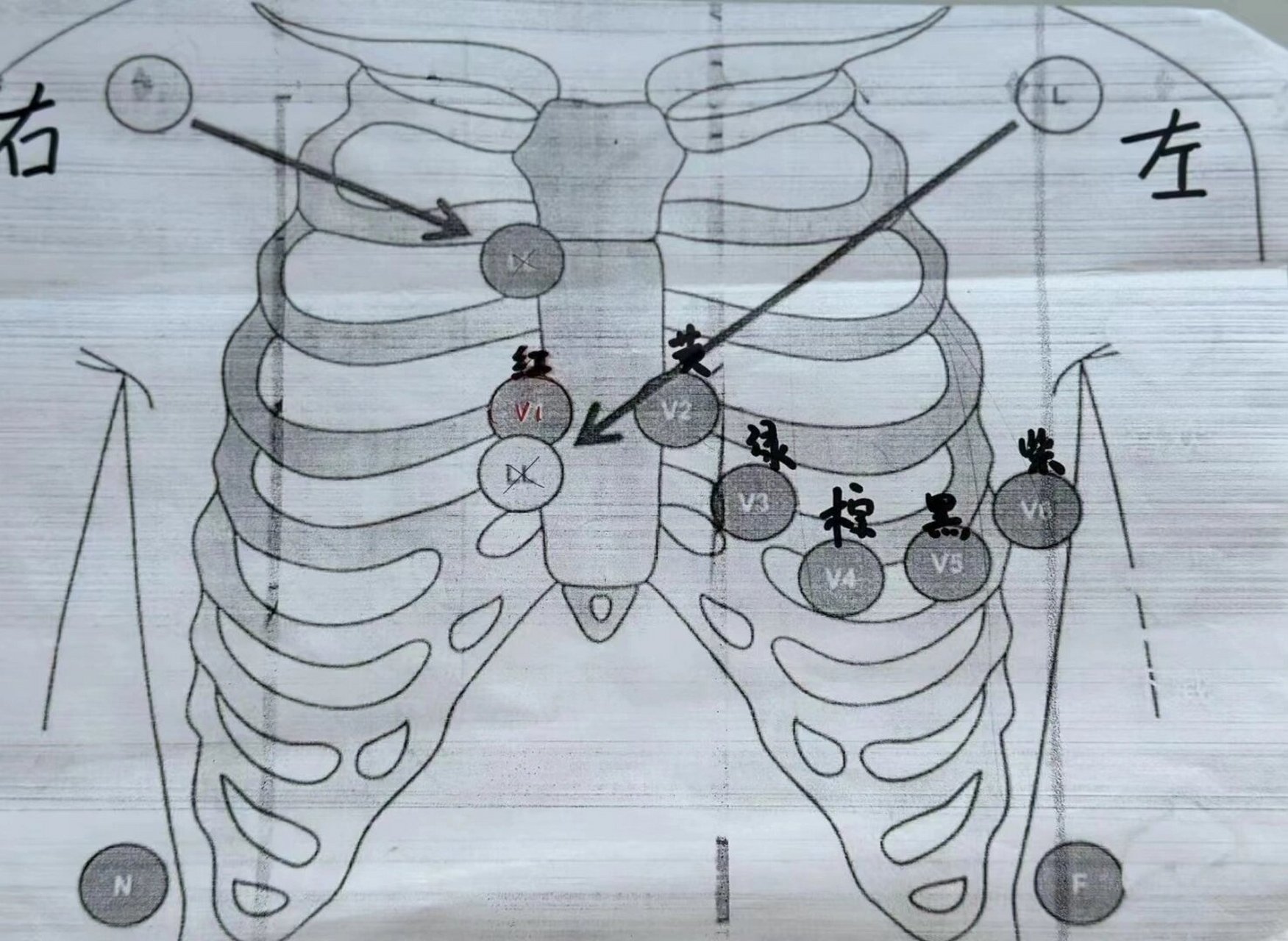 胸前导联位置及颜色 胸前导联: v1是红色,位于胸骨右缘第4肋间; v2是