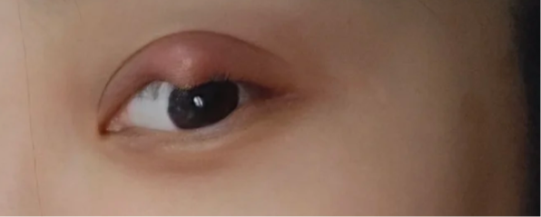 下眼皮里面长小疙瘩常见的原因有脂肪颗粒,霰粒肿或麦粒肿