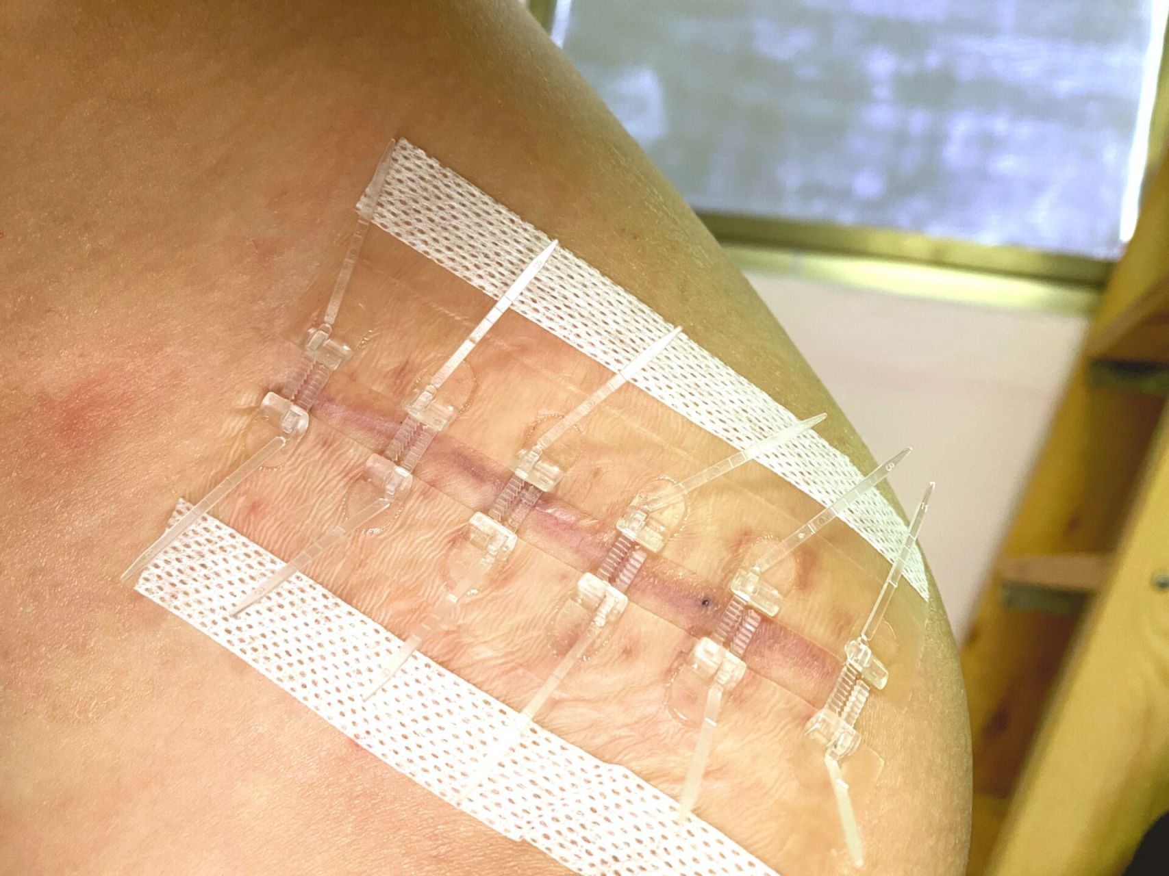 0202减张器小tips:如何避免起水泡    伤口拆线以后,张力比较大