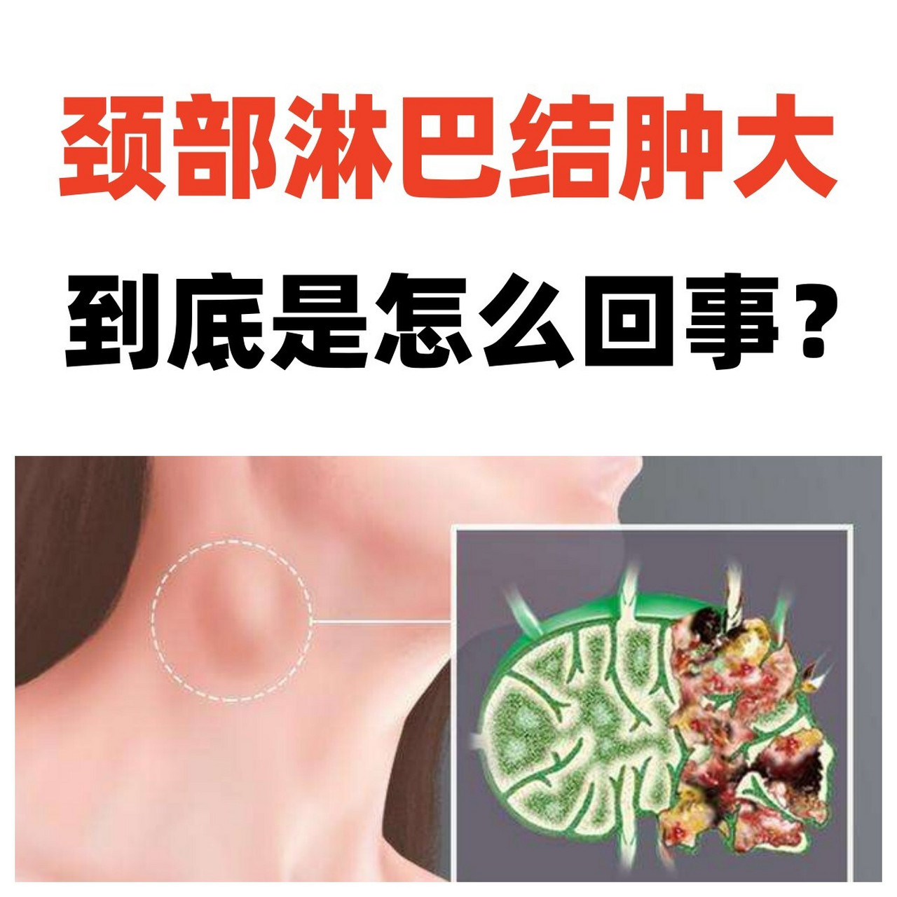 淋巴结肿大,快收藏这个方子 颈部淋巴结肿大,常见病因是炎症造成的