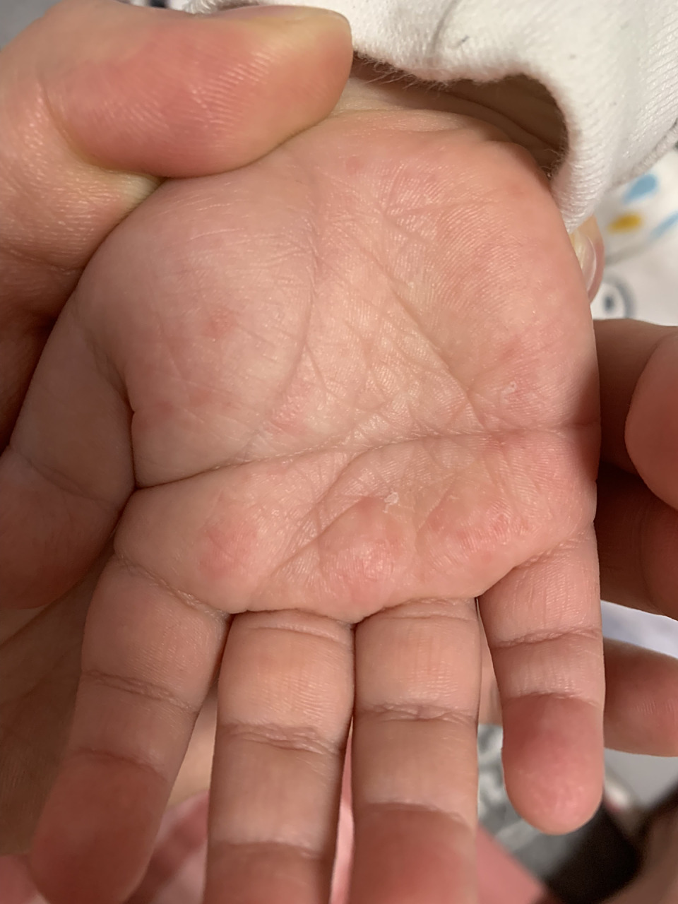 宝宝手心小红点 两岁的娃,手指脱皮,手心红红的,今天发现有小红点点