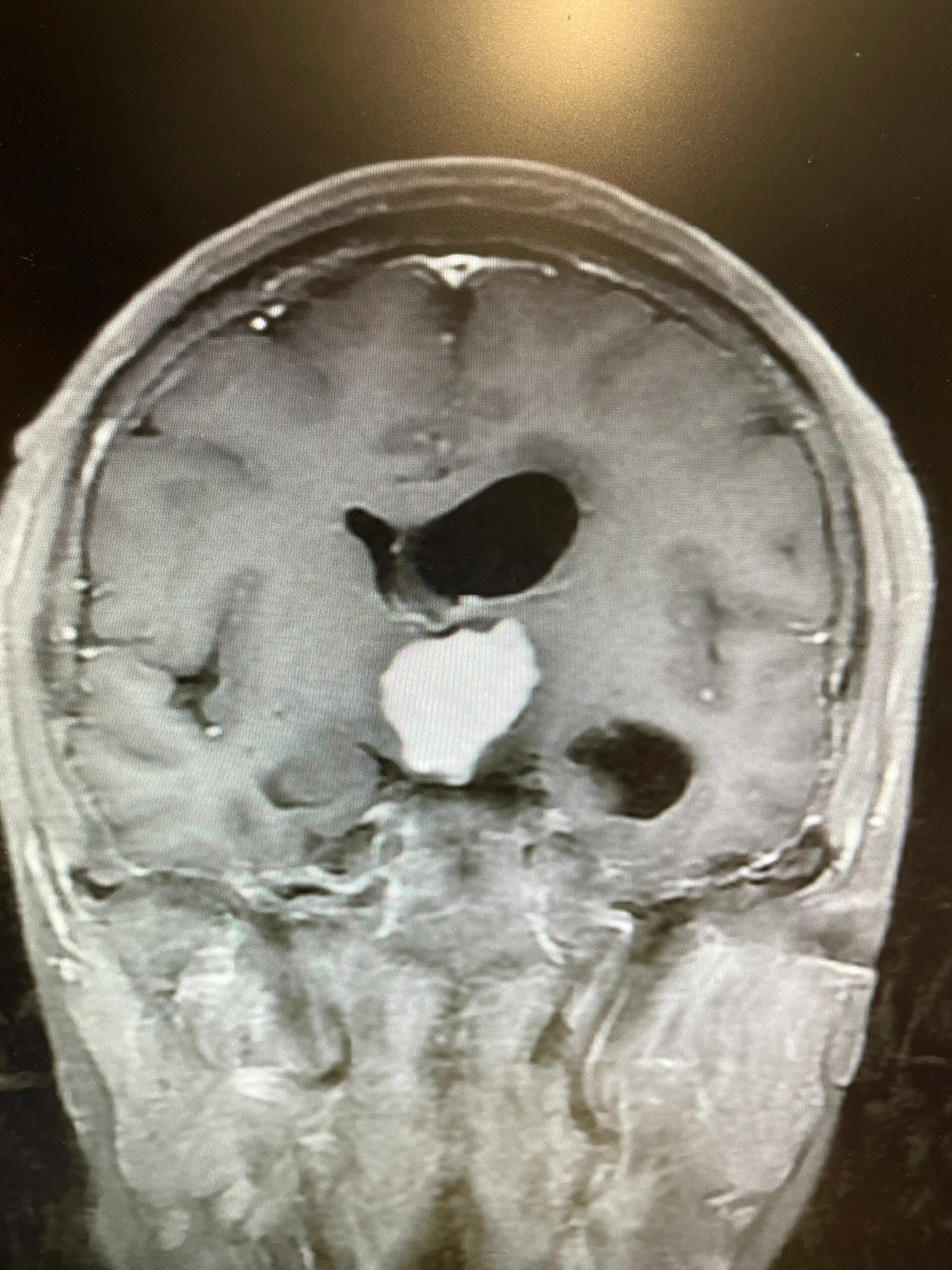 高难度胶质瘤 2024愿每个病人都手术顺利 中年女性,检查发现鞍区肿瘤6