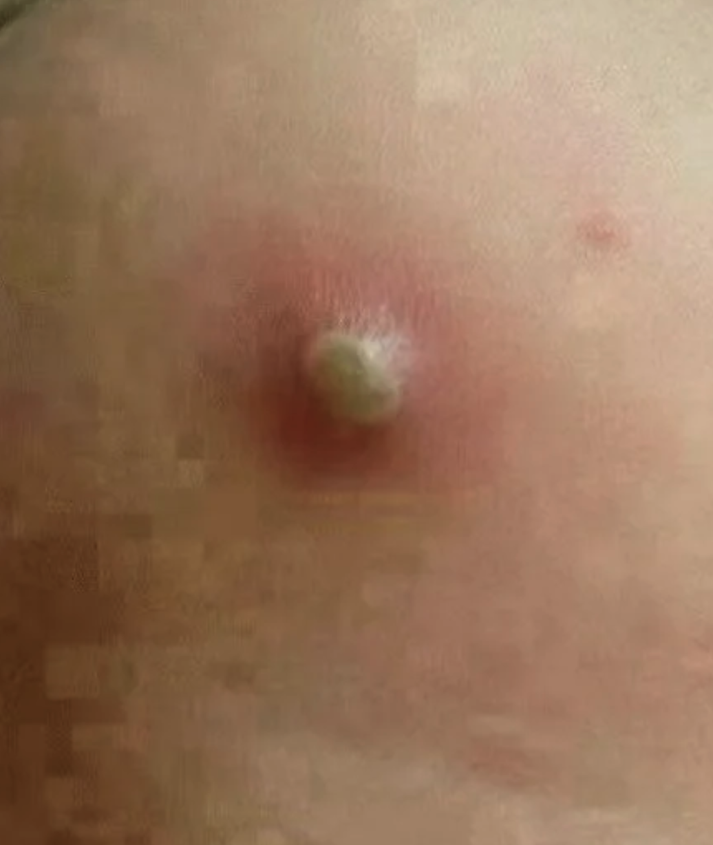 细菌感染引起的,当伤口或内脏感染后,局部会出现红肿,疼痛等炎症反应