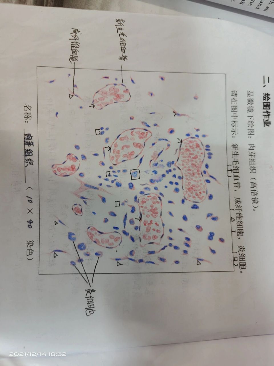 病理肉芽组织红蓝绘图图片