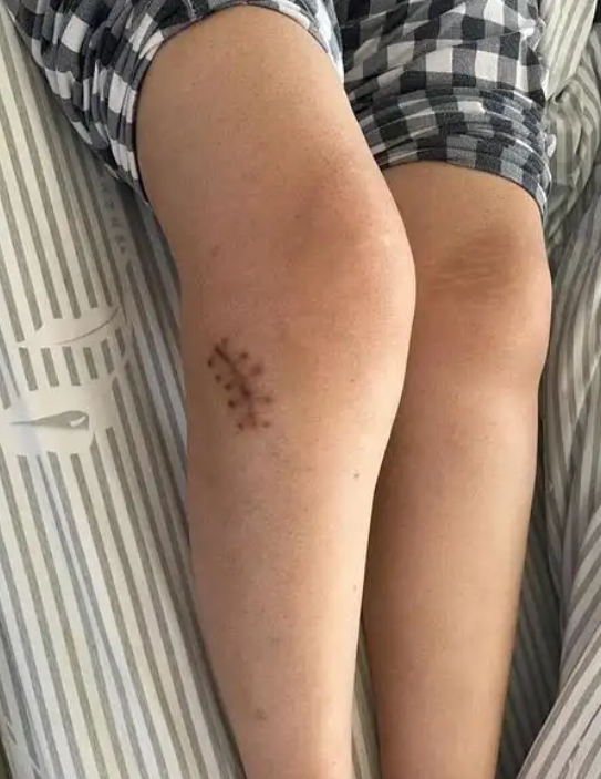 小腿侧面鼓包可能由几种常见原因引起,比如肌肉发达,腱鞘囊肿或志肪