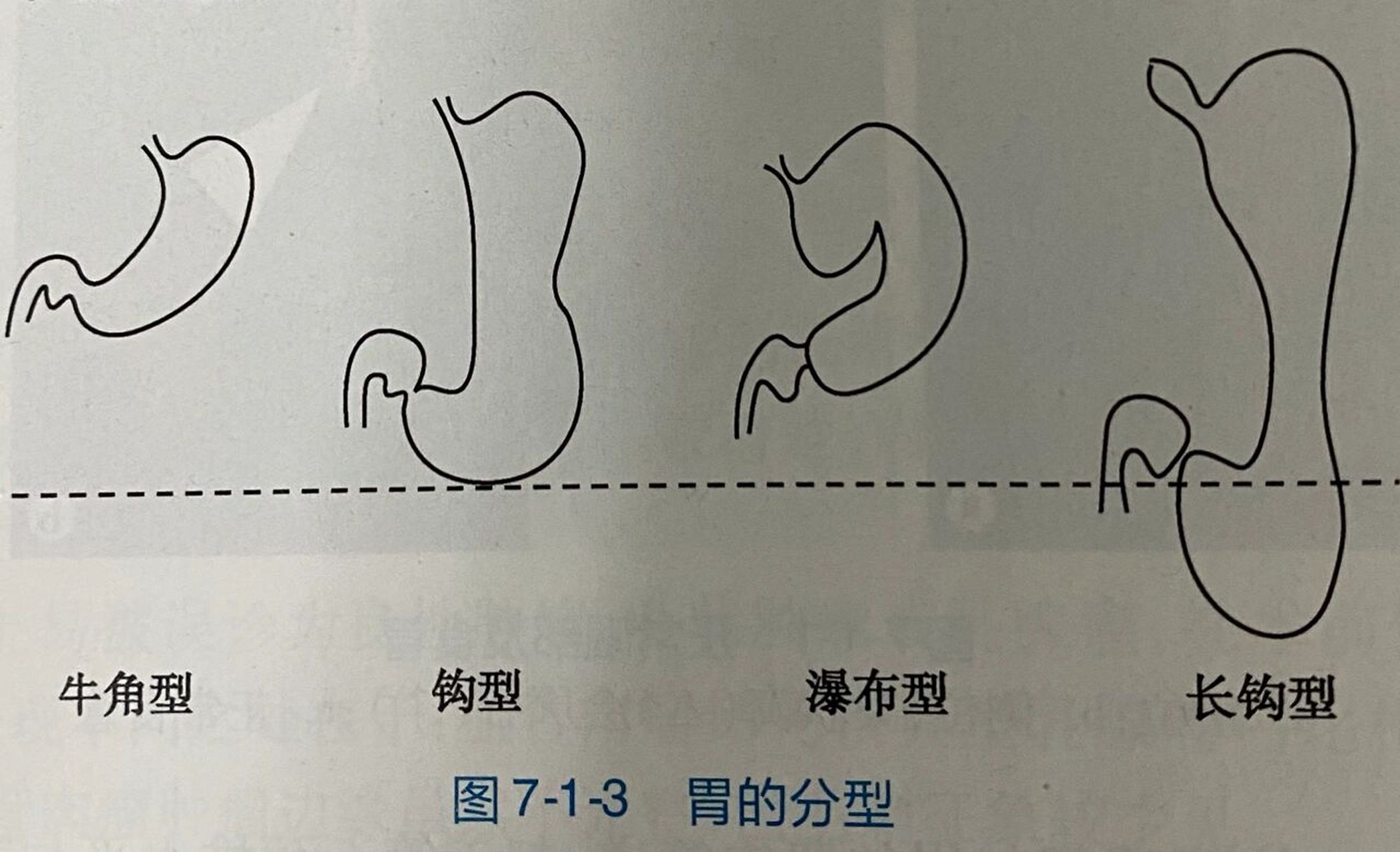 胃分型 胃的形状:胃的形状与体型,张力及神经系统的功能状态有关,一般