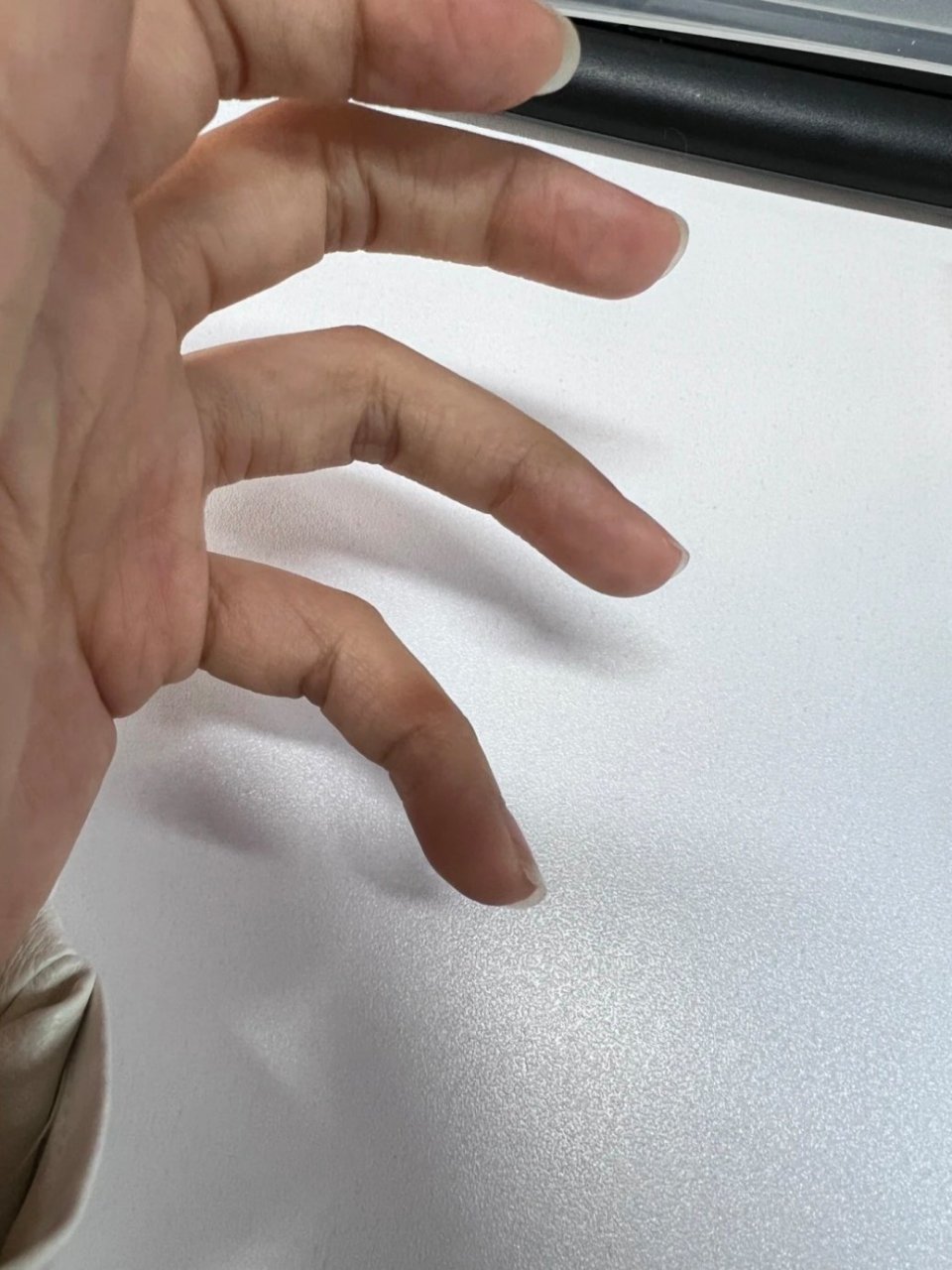 长时间托手机致小拇指变形# 这是真的,不骗人.