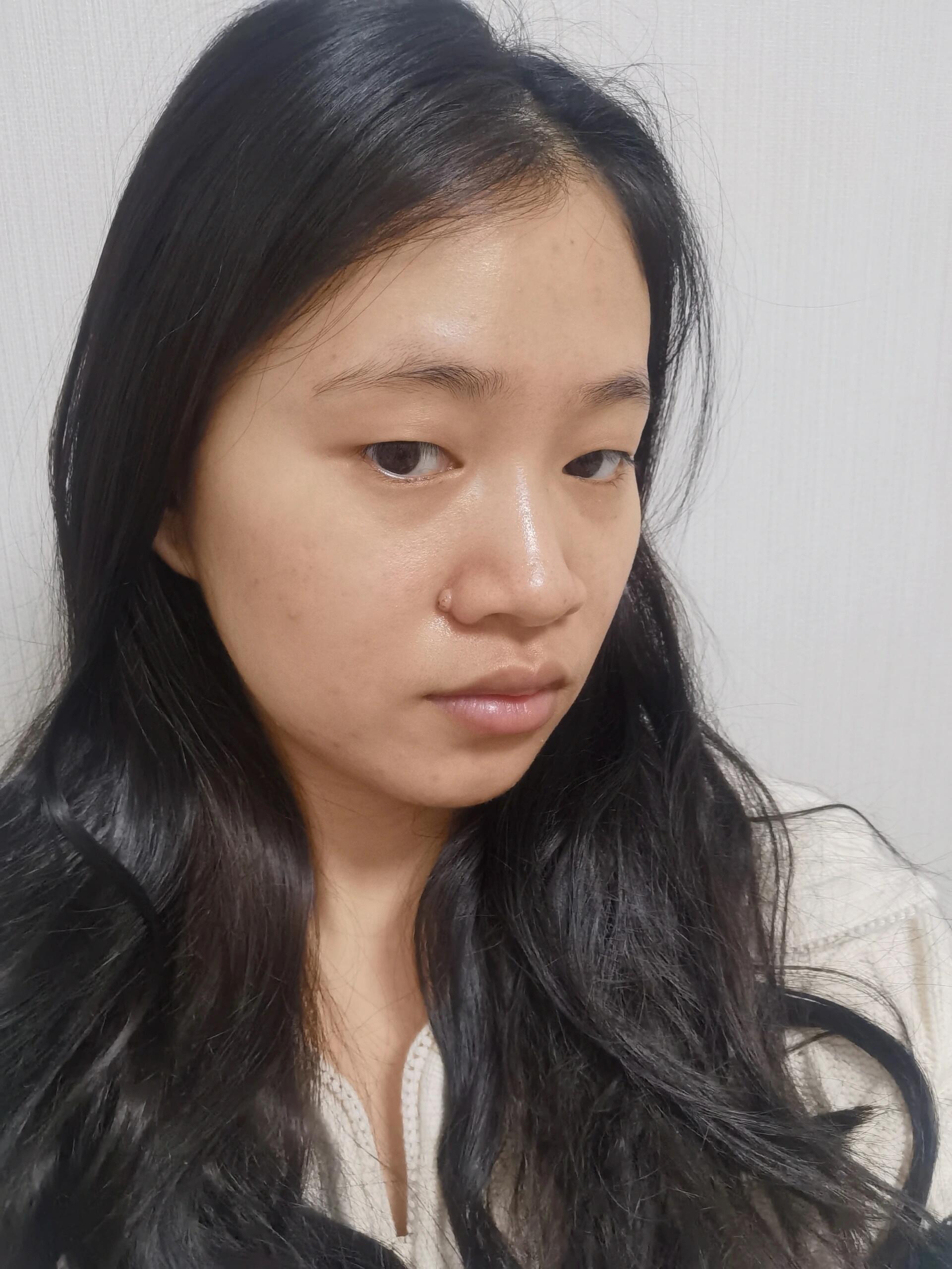 我的痣是在鼻翼左侧,从小就有,随着我长大痣也越来越大和明显,每次