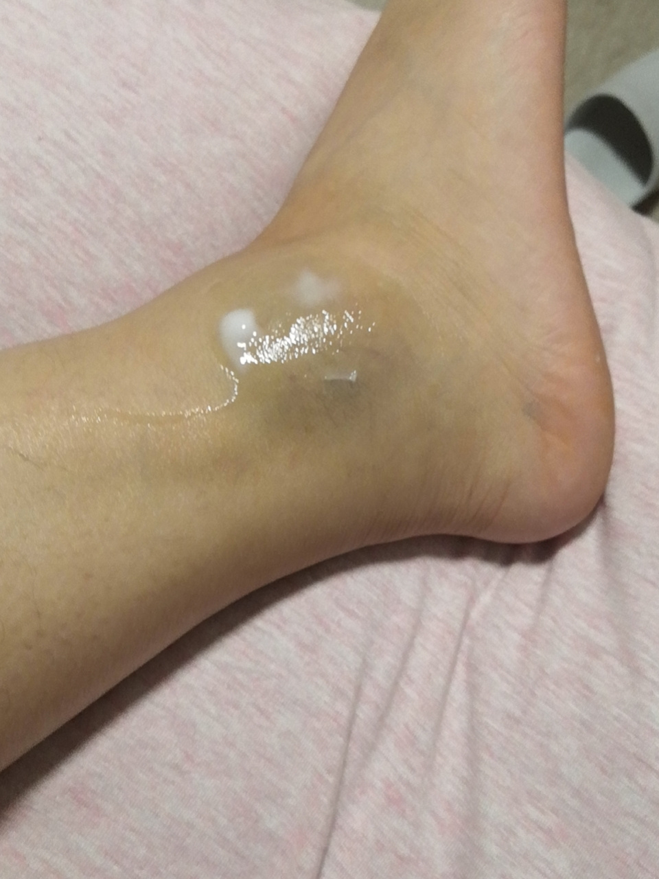 崴脚心路历程 前言:不管是什么原因造成的,最终结果就是踝关节扭伤也