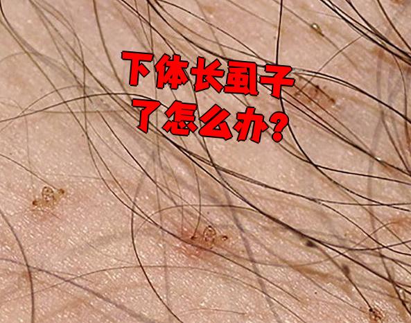 阴虱病是阴虱寄生在阴毛或肛门周围体毛上,叮咬皮肤后导致瘙痒的传染