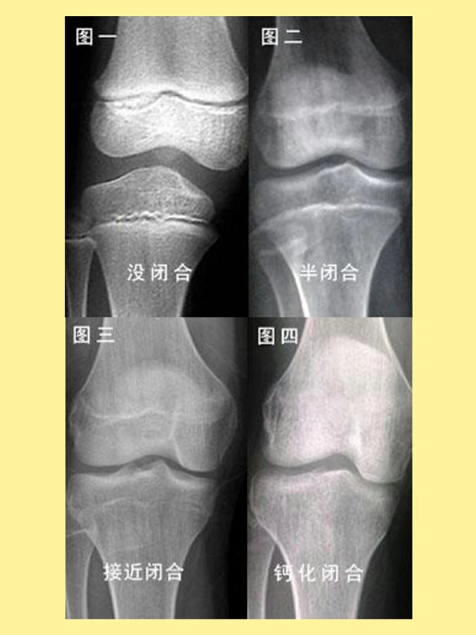 骨骺是什么图片看看图片