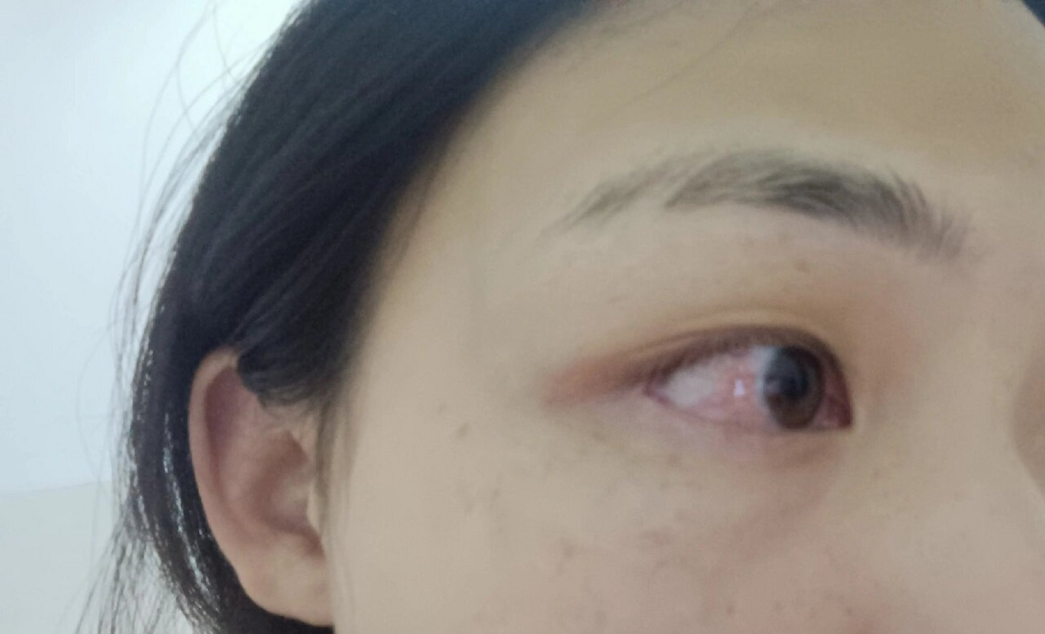 眼白色素痣 眼睛里这块色素已经很多年了,不敢跟人对视,怕别人发现,还