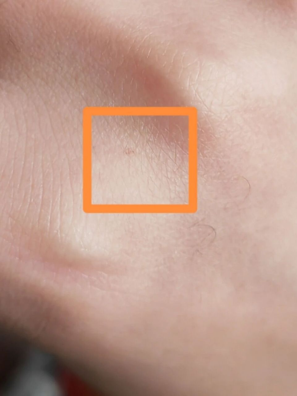 木刺扎进手里咋办 前两天有一根小木刺不小心扎进手里了.