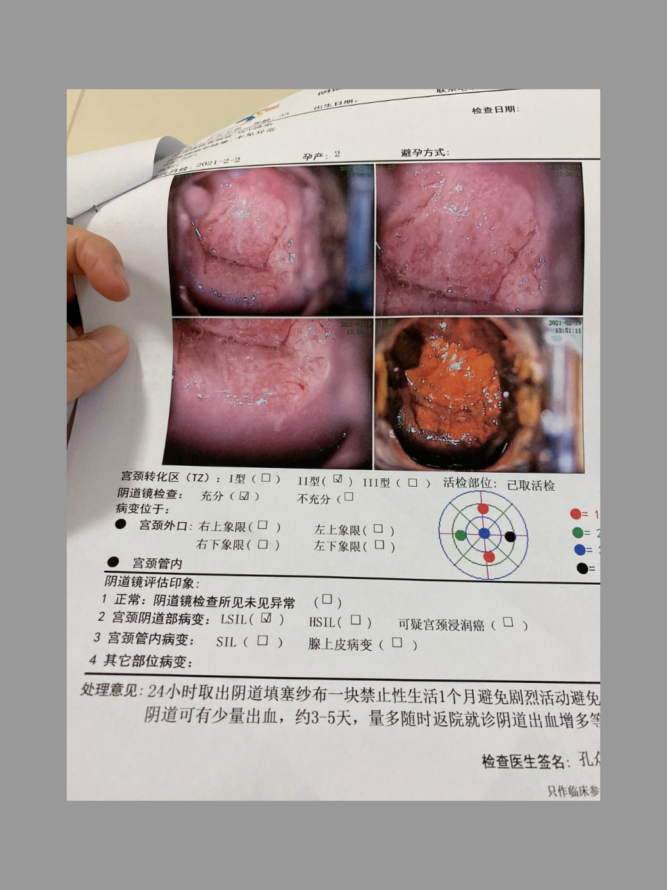 hpv活检 宫颈转化区2型,是癌吗?好害怕