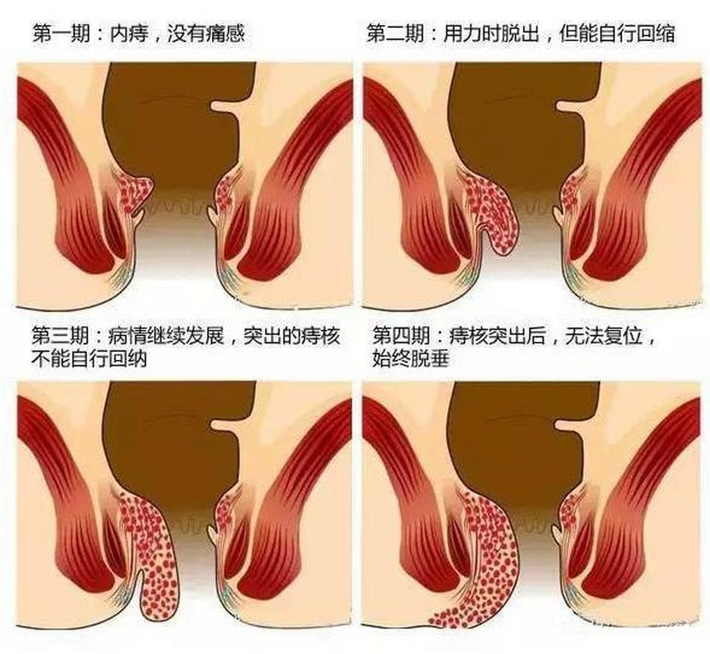 请问医生,痔疮出血严重吗?